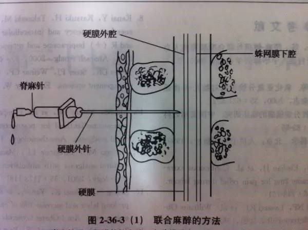 孕傻,剖腹產手術,腰麻